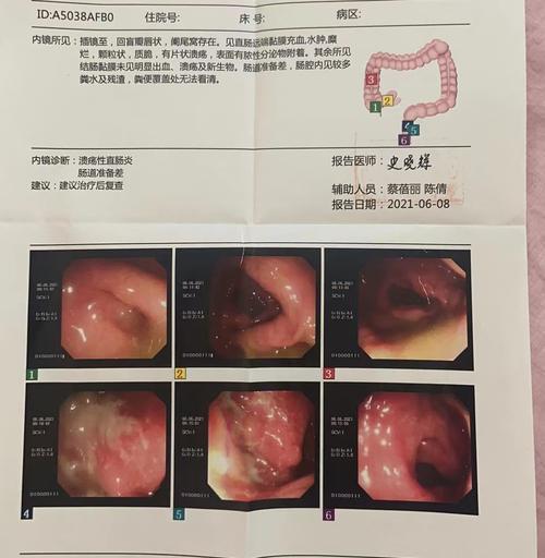 便秘（探究便秘的原因、症状和治疗方法）