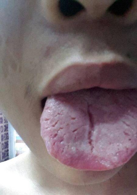 舌苔长毛的原因及处理方法（舌苔长毛的危害及预防措施）