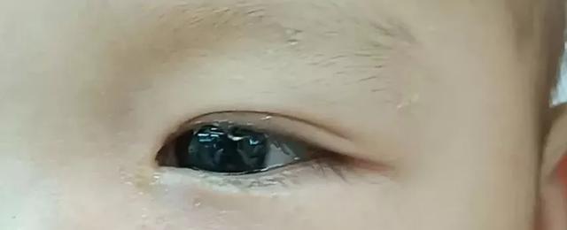 以泪鼻管堵塞的症状及治疗方法（了解泪鼻管堵塞可能导致的症状和寻求适当的治疗）