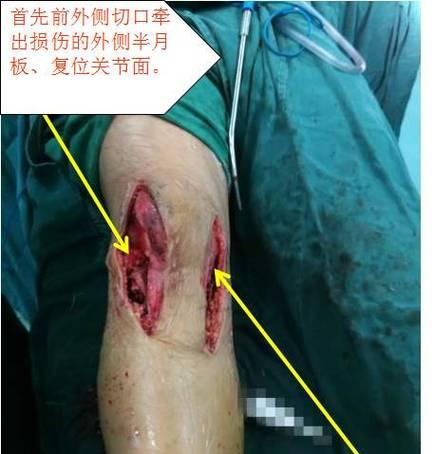 膝盖骨脱臼饮食保健知识（恢复膝盖骨脱臼所需的营养和食物）