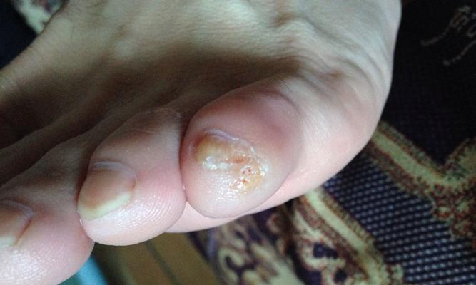 指甲炎康复指南（探索指甲炎患者走路康复的时间和方法）
