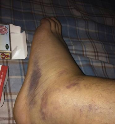 狗狗脚扭了多久能好？（康复时间、治疗方式和注意事项）